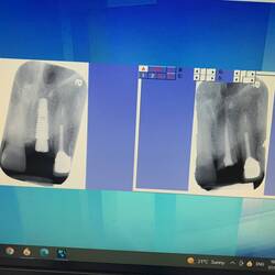 Old tooth on the right, new pin for attaching crown on the left