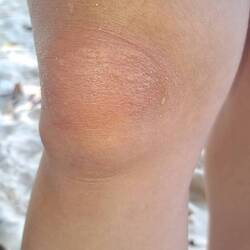 Ausschlag von Korallen