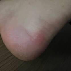 1st blister. Im a real pilgrim now!