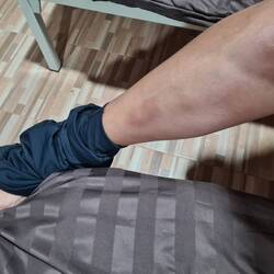 Direkt blaue Flecken