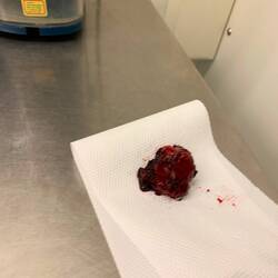 Verwijderde cyste/tummor?