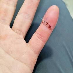 Die Wunde ging bis auf den Knochen und musste mit 4 Stichen genäht werden.
