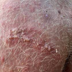 Wieder irgend so eine verbrennung. Von gestern.