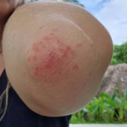 Mehr Mückenstiche - warum nur so viel am Ellenbogen