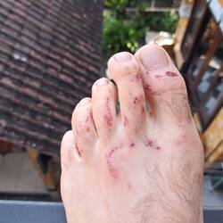 Korallen-Attacken auf Peters linken Fuß