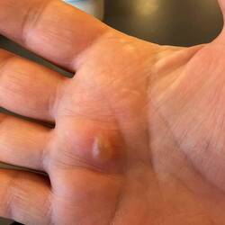 Blister on my palm caused by my heated handlebar grips