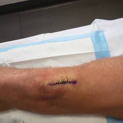 Rainer wurde am Knie operiert (kein Arbeitsunfall!)