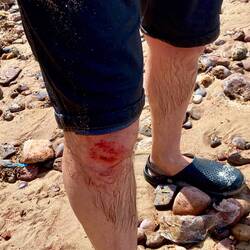 Gezeichnet vom Sturz