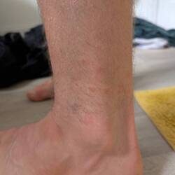 Die Folgen der Migets. Miese Viecher