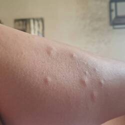 Meine von Mücken Stichen geplagten Beine