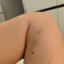 Probably a handlebar bruise