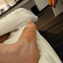 There's actually not much bruising on the foot!