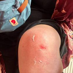 Ctrl + alt + deleted my knee skin haha