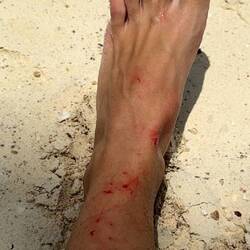 Jasmin verletzter Fuss