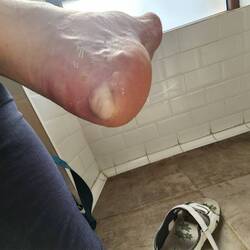 Huge blister on my other foot too