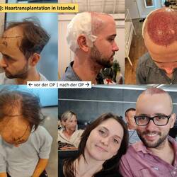 Also ging es in die Türkei um meinen ungleichmäßigen Haarwuchs ein bisschen ausgleichen zu lassen