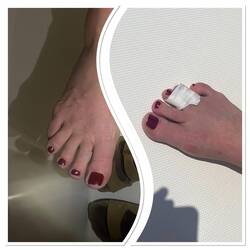 Gebrochener Zehe wieder zusammengeflickt 🙈😂