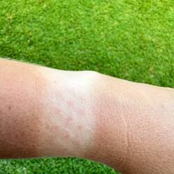 Ich hatte noch nie so einen Abdruck von meiner Uhr. Die Sonne war brutal gestern.