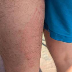 Schöne Schürfwunde