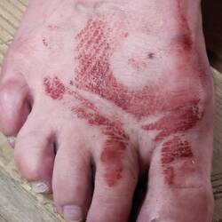 A leech bite. They go through socks and bite. Moe had 4 in total on foot and leg