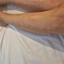 Deswegen zieht man lange Hosen, auch bei 25 Grad an 🥸 160 Stiche an beiden Beinen 🥵