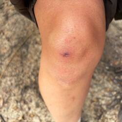 Das Knie tut weh und wird dick 😢