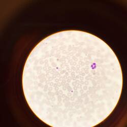 Malaria. In einigen roten Erythrozyten sieht man blaue Malaria Erreger