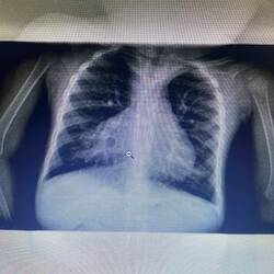 Kardiomegalie eines Mädchens mit Downsyndrom (Erstdiagnose)