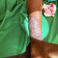 Mysteriöse Hauterkrankung, Diagnose steht aus