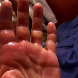 My hand is not getting better, I think there are still tiny splinters in there