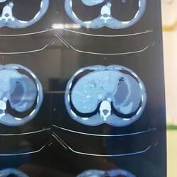 Verletzungen an Milz und Leber im CT