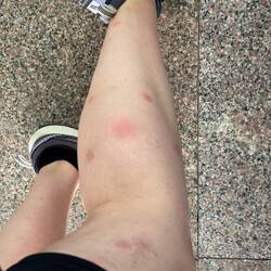 Die Mücken hier sind übel haha