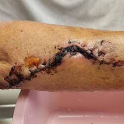 My right arm today (Wednesday). Looking 'good'?🥴