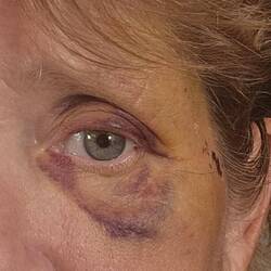 My black eye continues to evolve