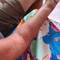 Sting anaphylaxis, fascinating watching the spread. Was it a bee or an ant?