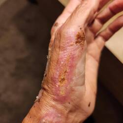 My left hand is still in a bad way 🥴