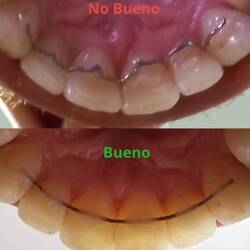 Old and broken Retainer vs. New Retainer