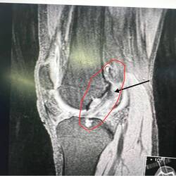 Normal intact ACL
