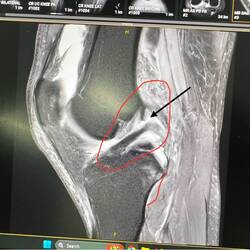 My Snapped ACL
