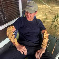 Kartoffel gegen Sonnenbrand ☺️