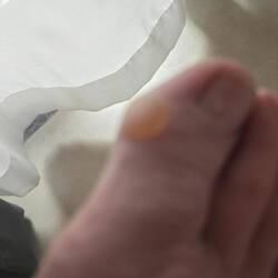 Sorry about the blur, but the blister wasn't going away