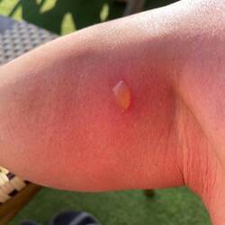 Sorry 🫣 little war wound from a plant!