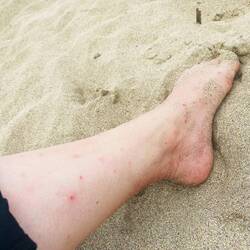 Alina wird in Costa Rica von Sandfliegen geplagt 🪰