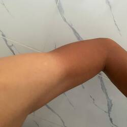 The obvious dual skin color on my arm