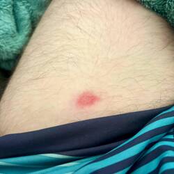 Tick Bite