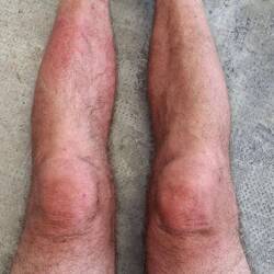 Mijn benen zien alle variaties van rood.