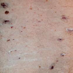 15 entry points. 7 into the vertebrae and 8 facet joint ablations.