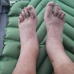 My feet are normally pretty ugly. The swollen left ankle has been a problem.