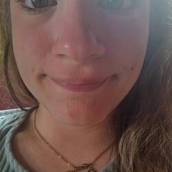 Sonnenbrand in der Fresse