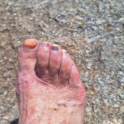 Only going to lose one toenail...pretty lucky really 😂